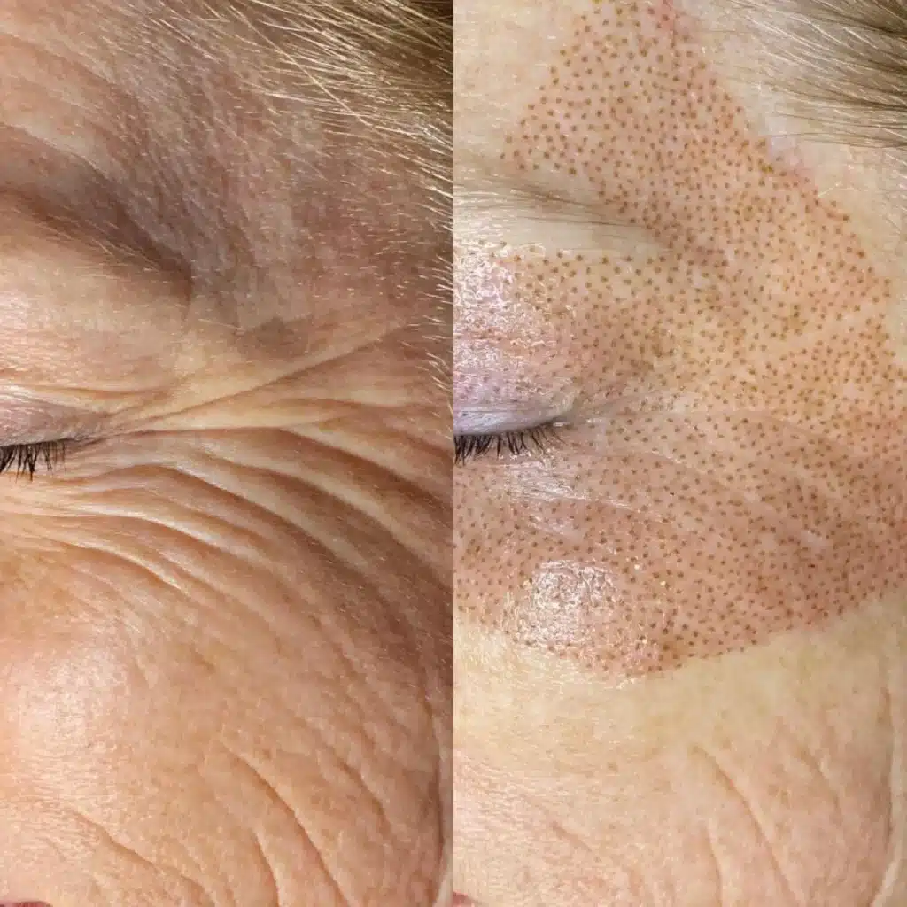 Intense Pulsed Light (IPL) Treatment