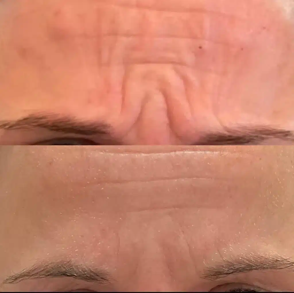 Dysport & Xeomin