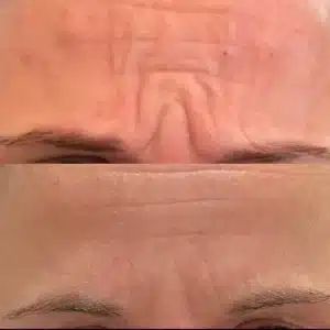Dysport & Xeomin