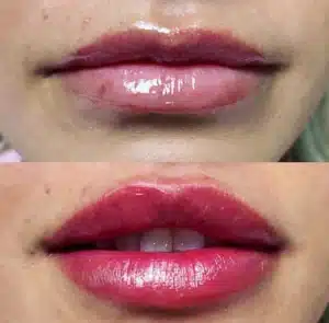 Filler Injections