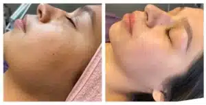 Microneedling