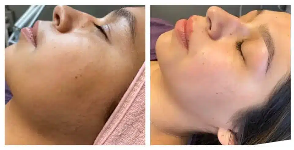 Microneedling