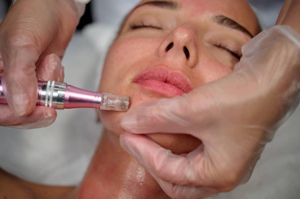 collagen induction therapy