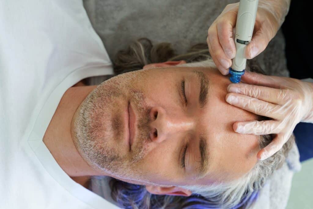 Microneedling Treatments for Men and Women