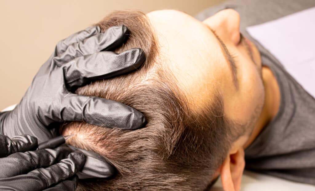TED Hair Restoration
