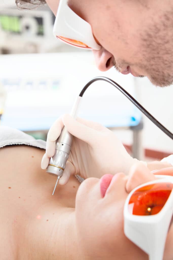 Skin Tag/Mole Removal with Plasma Pen