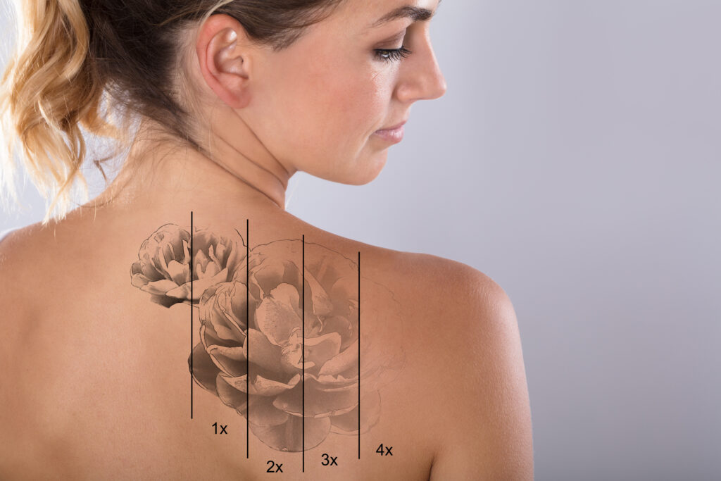 Laser tattoo removal